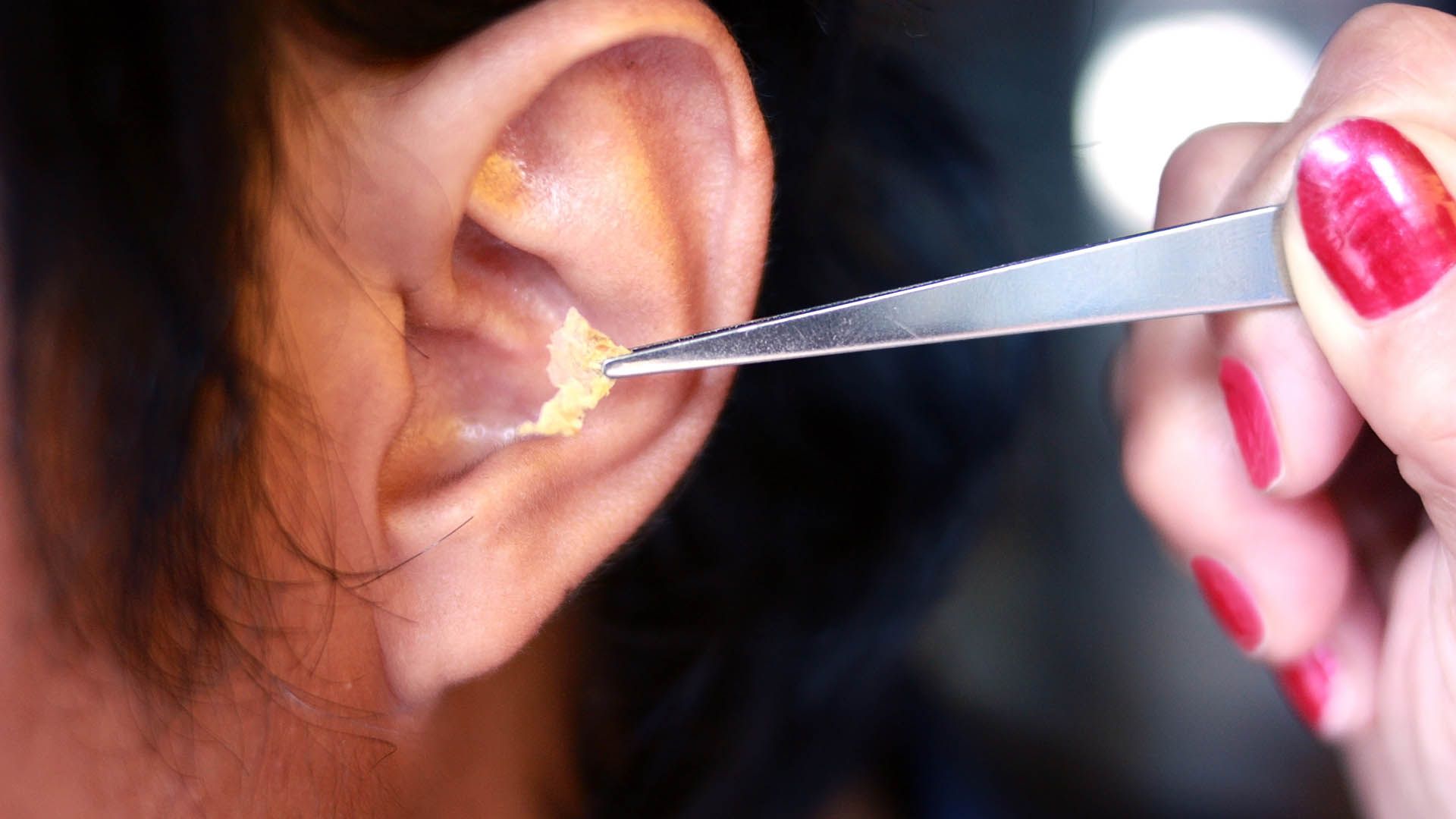 Earwax Removal
